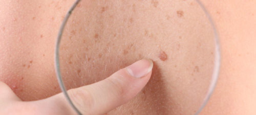 moles on skin