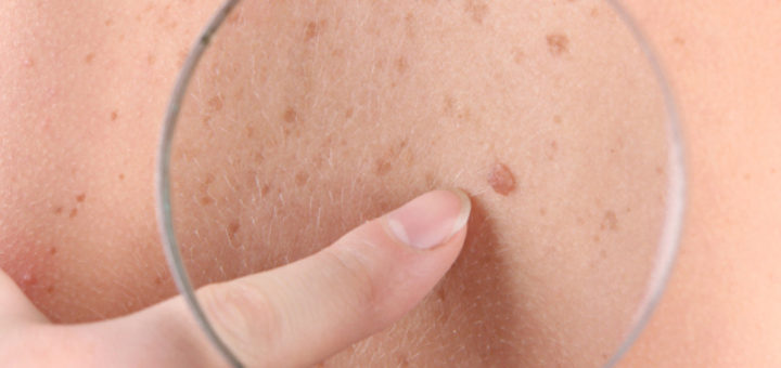 moles on skin