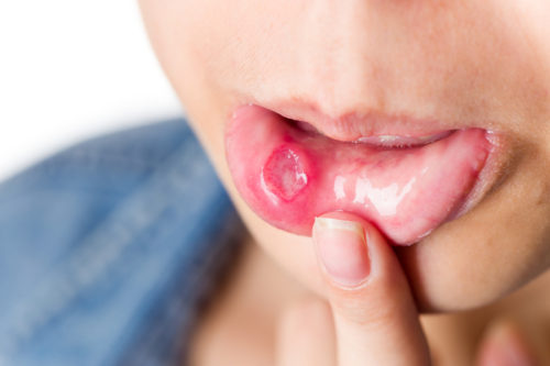 mouth ulcers