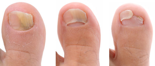 get rid of nail fungus