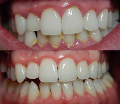 plaque on teeth