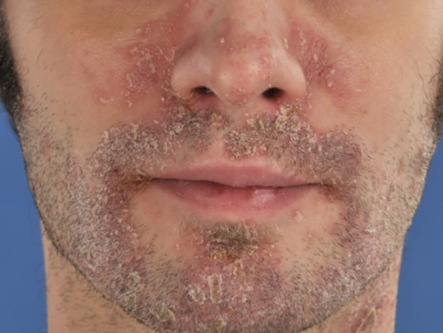 psoriasis on face