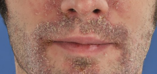 psoriasis on face