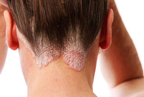 psoriasis on scalp