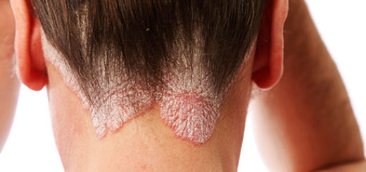 psoriasis on scalp