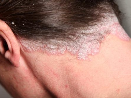 psoriasis on scalp