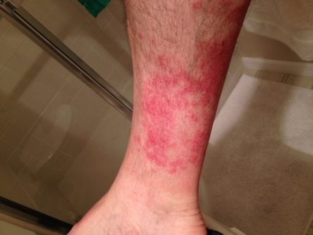 rash on legs pictures