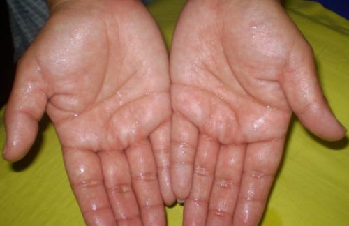 get rid of sweat hands