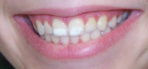 teeth white spots