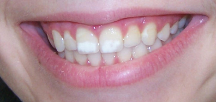 teeth white spots