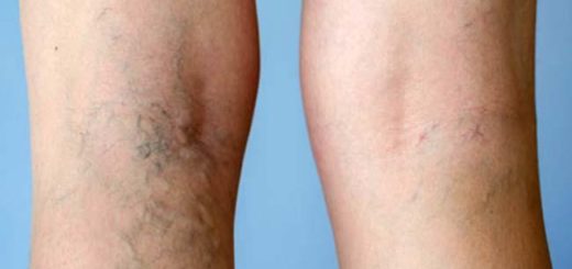 varicose veins