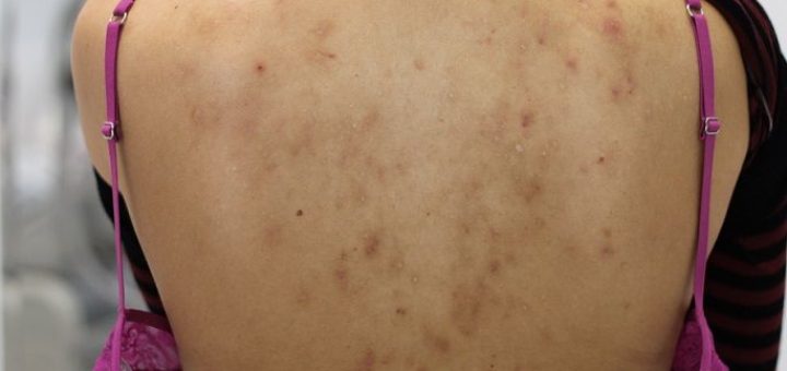 acne scars on back