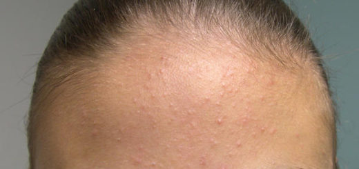 bumps on forehead