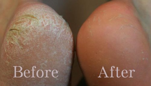 get rid of cracked heels