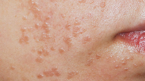 get rid of flat warts