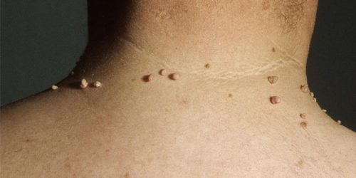 skin tags on neck