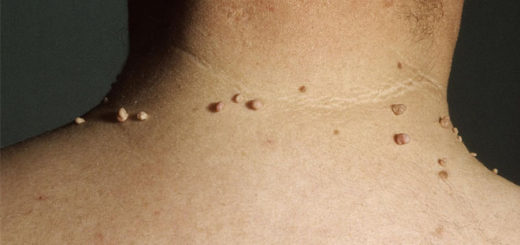 skin tags on neck