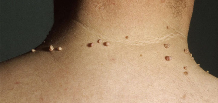 skin tags on neck