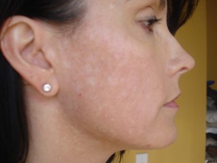 white spots on face