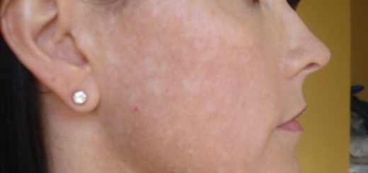white spots on face